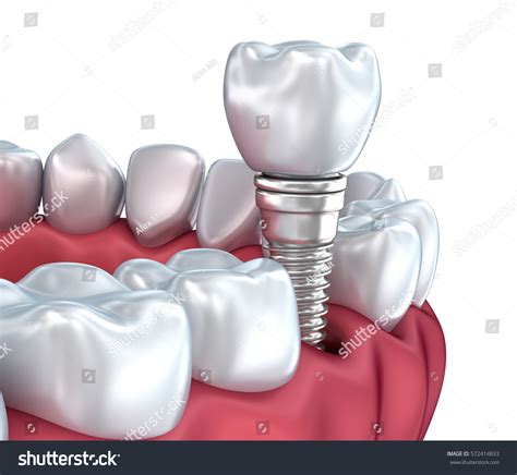 Tooth Implant Medically Accurate 3d Illustration Stock Illustration 572414833 Shutterstock