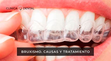 Bruxismo Causas y Tratamientos Clínica Dental Gran Vía