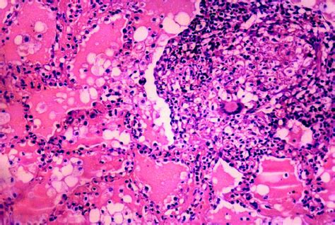 Histopathological Exam H E Lung Tissue With An Altered Structure