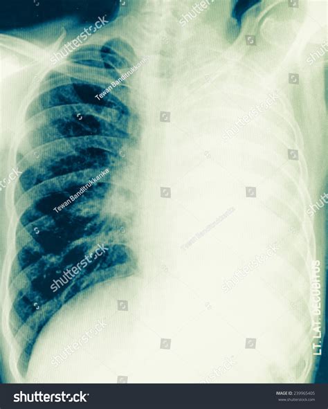 Chest Film View Cavity Right Lung Stock Photo Shutterstock