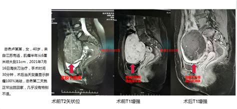 11厘米后壁血流丰富子宫肌瘤海扶刀治疗病例 陈谦主治医师 爱问医生