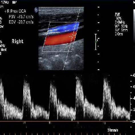 Demonstrates Psv Of The Common Carotid Artery Psv Peak Systolic Velocity Download