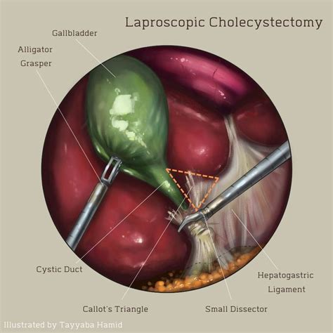 Laproscopic Cholecystectomy Illustrated By Me Medizzy