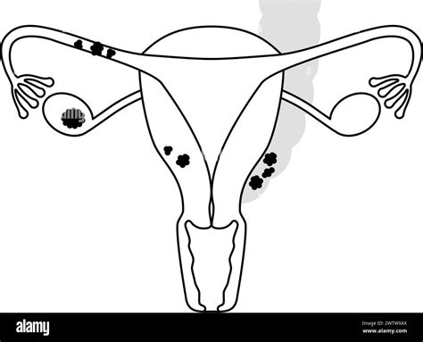 Diagrammatic Illustration Of Stage Ii Ovarian Cancer Anatomy Of The