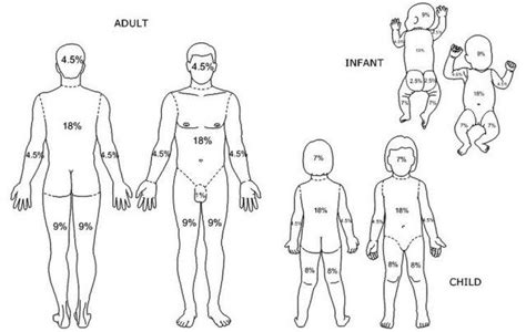 Calcolare La Superficie Di Una Ustione La Regola Del 9 In Neonati
