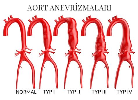 Aort Anevrizmalar Prof Dr Tayfun Aybek