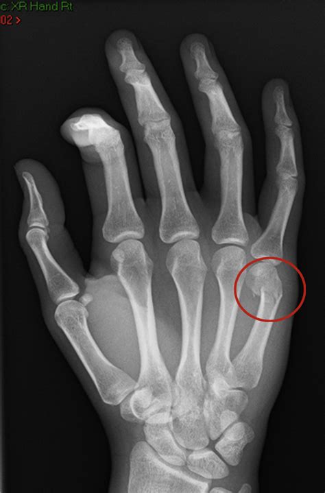 Metacarpal Fractures Lothian Virtual Hand Clinic