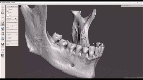 Convert Dicom Ct To Stl File 3d Printable Youtube