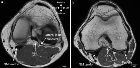 Axial Mr Images Illustrating A Expansion Of The Sm Tendon Into The Opl