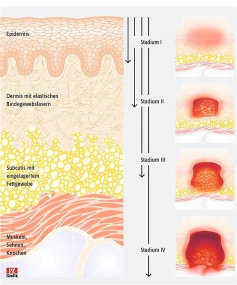 Pharmazeutische Zeitung Online Dekubitus Last Und Entlastung