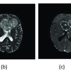 Different Modalities Of MRI Images A T1 B T2 C T1c And D