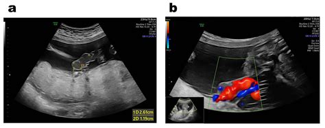 The Value Of Antenatal Ultrasound In Diagnosing Anatomical And Morphological Abnormalities Of