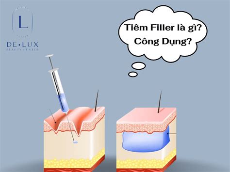 Tiêm Filler Là Gì Địa Điểm Tiêm Filler Số 1 Việt Nam