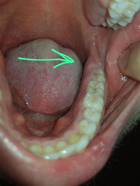 One Of My Wisdom Teeth Is Partially Covered With Gum It Gets Inflamed Frequently Should I