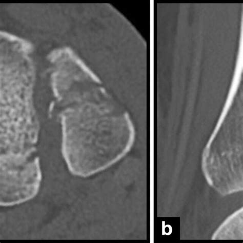 Ct Scan With A Dislocated Intercalary Fragment In The A Axial And B