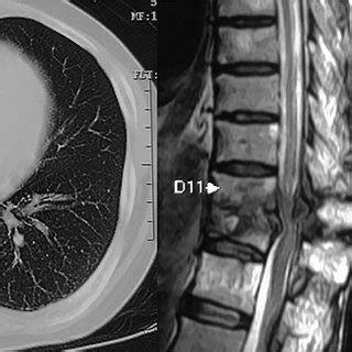 Thoracic Contrast Enhanced Computed Tomography Showing Loculated