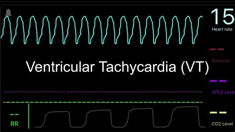 Heart Rhythms For Emts And Aed Use Youtube