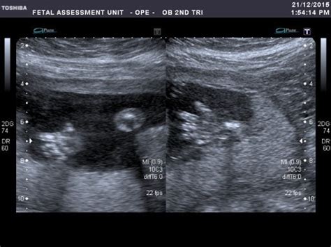 Pregnancy: The second trimester - 20-week anomaly scan + gestational ...