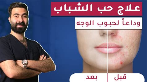 تخلص من حب الشباب وحبوب الوجه بأسرع طريقة علاج حب الشباب في 5 أيام