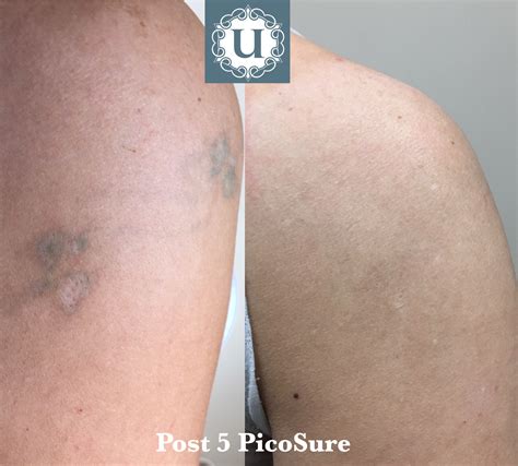 Green ink tattoo removal - PicoSure is very effective for green and blue ink