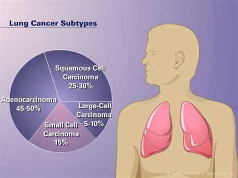 Squamous Non Small Cell Lung Cancer Symptoms - CancerWalls