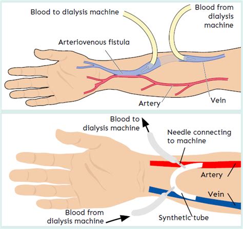 Dialysis Fistula Diagram