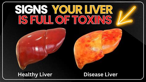 Signs Your Liver Is Full Of Toxins Youtube