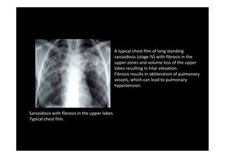 Interstitial Lung Disease X Ray