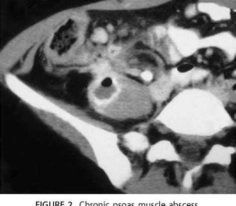 Figure 2 From Sterile Seroma After Surgical Drainage Of Purulent Psoas Abscess In Crohns