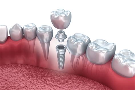 Osseointegration Midwest Oral Surgery And Dental Implants