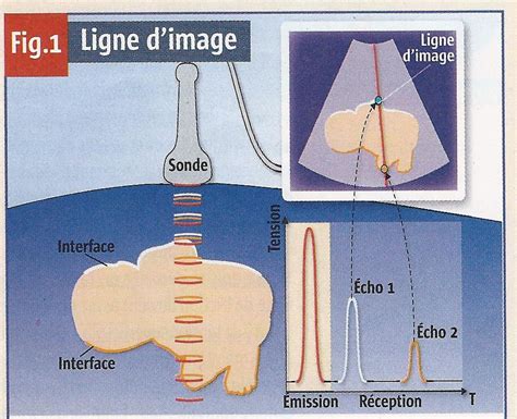 Le fonctionnement de l échographie