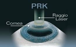 Testimonianza Di Intervento Di Chirurgia Refrattiva PRKMarco Mistretta