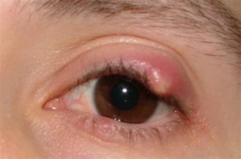 Eyelid Pimple