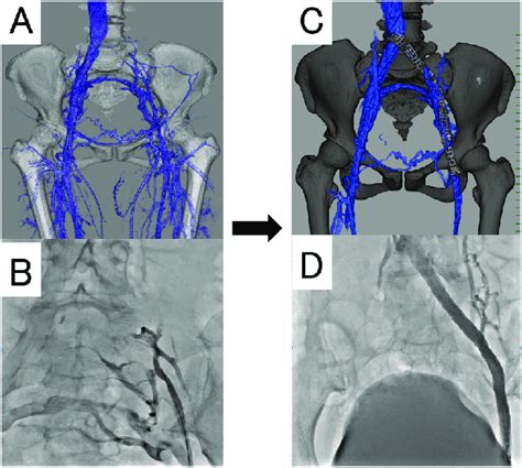 Postthrombotic Iliac Vein Occlusion And The Venous Stenting A