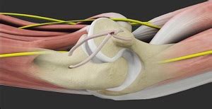 UCL Reconstruction - Academy Orthopedics