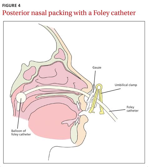 Posterior Nasal Packing Informacionpublica Svet Gob Gt