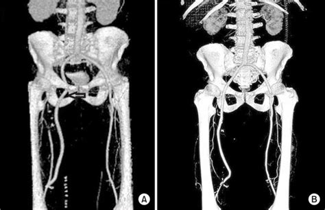 Aortobifemoral Reconstruction With Right Extra Anatomic Obturator Foramen Bypass Due To A Septic