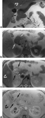 Mri Of Carcinoid Tumors Spectrum Of Appearances In The