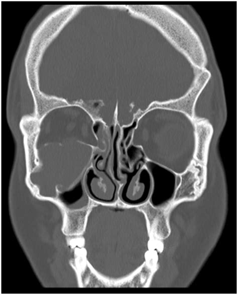 A Rare Presentation Of A Mucocele In A Separate Compartment Of