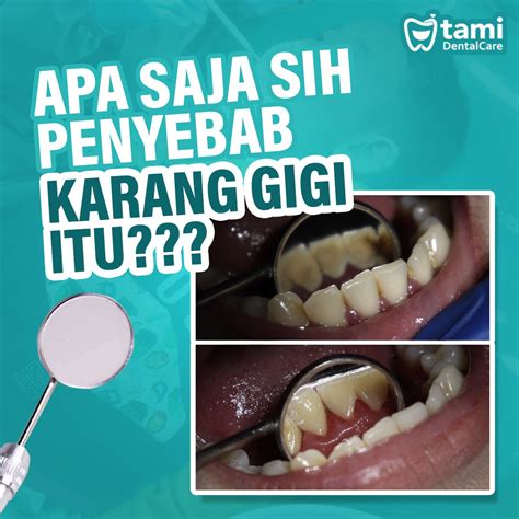 Apa Aja Sih Penyebab Karang Gigi Tami Dental Care Klinik Dokter Gigi Bandung Bojongsoang