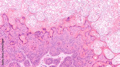 Microscopic Image Of A Proliferating Epidermoid Cyst A Type Of Epidermal Inclusion Cyst