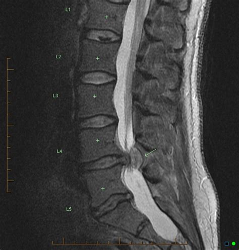 Extruded Lumbar Disc Encircling The Thecal Sac Image