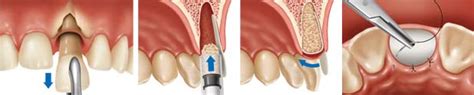 Bone Grafting Procedures Methuen Periodontics And Implant Dentistry