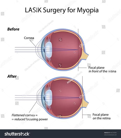 Lasik Eye Surgery For Myopia Stock Photo 94216594 : Shutterstock