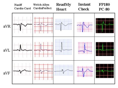 ECG Interpretation Flashcards Quizlet