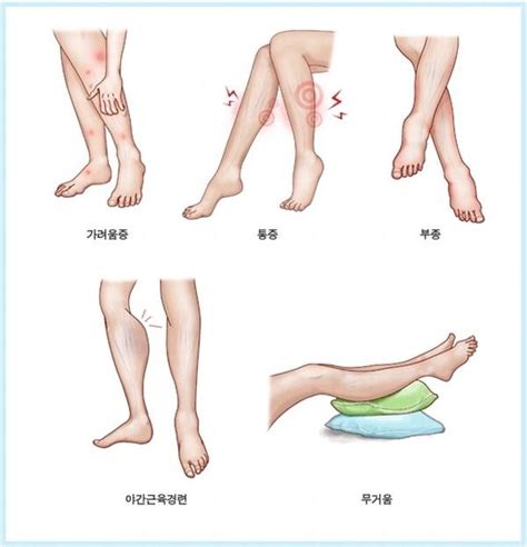 `울퉁불퉁 핏줄` 하지정맥류 원인 초기증상 치료법 부산일보