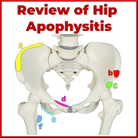 Review On Hip Apophysitis Sports Medicine Review Rorthopaedics