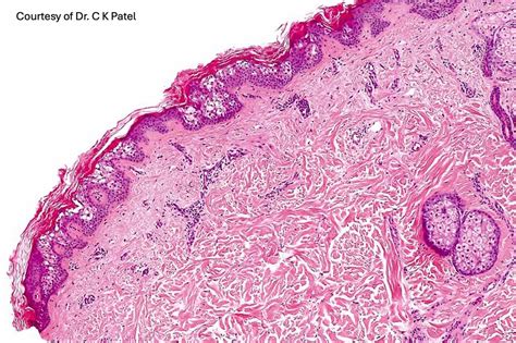 Epidermolytic Acanthoma Mckee Derm