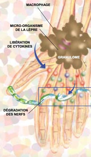 Orage De Cytokines Quand Le Syst Me Immunitaire Semballe Pour La