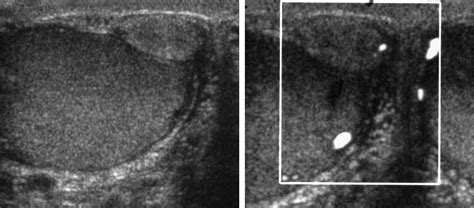 Ultrasound Findings Of Masses Of The Paratesticular Space Clinical